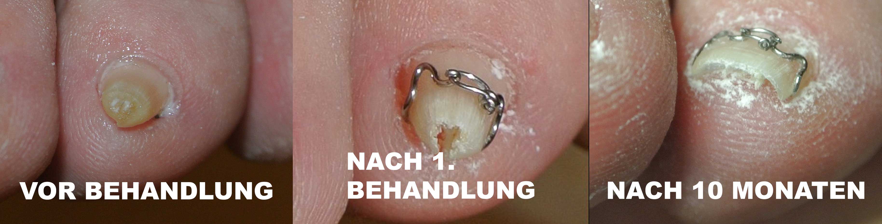 Bild_eingewachsener_Nagel_sofort_bis_10_Monate_nach_Behandlung